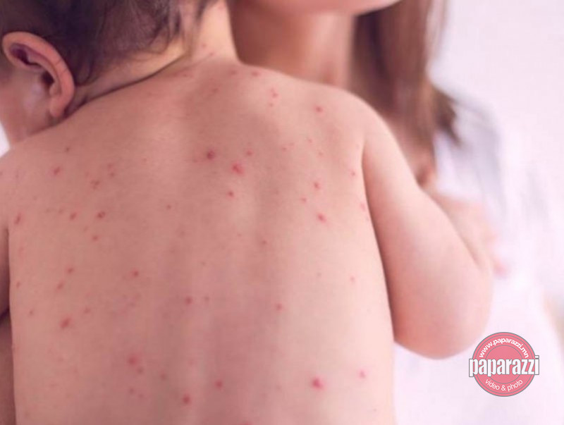 ХӨСҮТ: Улаанбурхан өвчний батлагдсан тохиолдол 27 нэмэгджээ