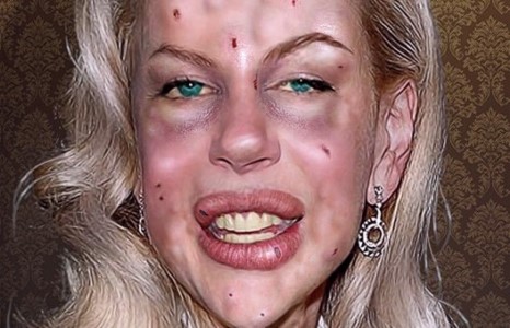 Николь Кидман ботоксыг хэтрүүлэн хэрэглэдэг байна