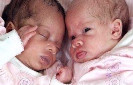 Хоёр өөр өнгөтэй ихэр мэндэлжээ