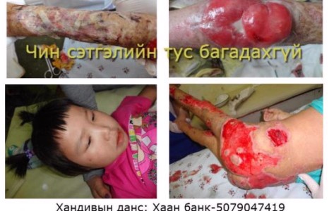 Эмч нарын хариуцлагагүйгээс болж дөрөвхөн настай охин үхлийн ирмэг дээр өдөр хоногийг өнгөрүүлж байна