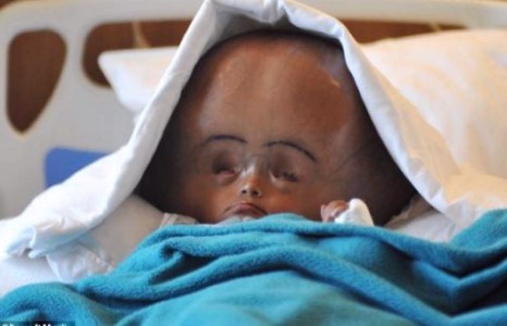 Тархины усжилтын улмаас аварга толгойтой болсон охинд мэс засал хийв