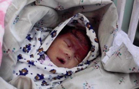 Согтуу эмчийн буруугаас нярай хүнд гэмтжээ