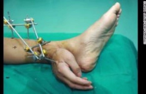 Тасарсан гарыг хөлийн булчинд нь залган эмчилжээ