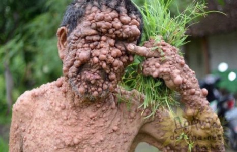 Ийм ч өвчин байх гэж