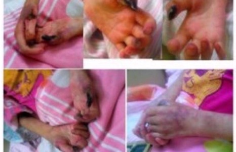 Вакцин тариулсан охины хуруу, хэл нь үхжиж, хөл дээрээ босох тэнхэлгүй болжээ