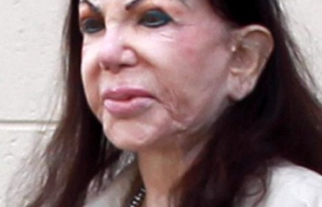 Сталлонегийн ээж хэтэрхий олон мэс засал хийлгэсэндээ харамсдаг