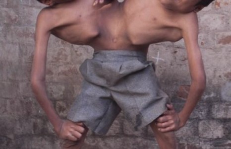 Энэтхэгийн сиамын ихрүүд