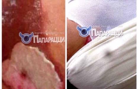 Жүжигчин Алдармаа өөрийгөө хохирогч хэмээн түлэгдсэн зургуудаа дэлгэлээ