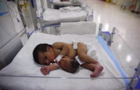 Охины гэдсэн дээрх бас нэг толгойг авсан мэс засал