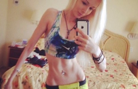 Анорекситэй бүсгүй бодигоор хичээллэх болжээ