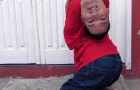 Төрөлхийн хүзүүний булгаралттай ня-бо залуу