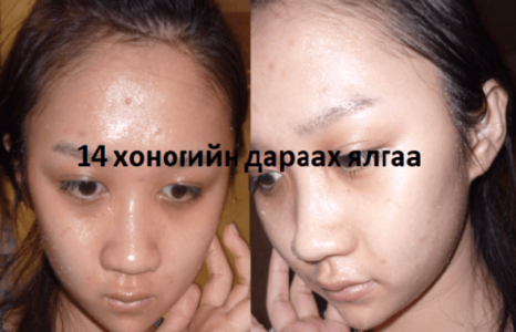 НҮҮРЭНД ХҮЙТЭН , ХАЛУУН УС ЯМАР ЧУХАЛ НӨЛӨӨ ҮЗҮҮЛДЭГ ГЭЭЧ …