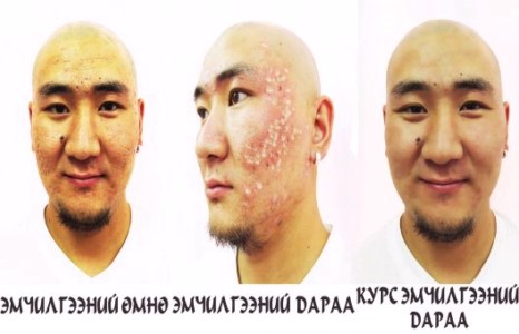 ОУ-ын арьсны мэргэжилтнүүдийн баталсан СЭВХ, БАТГАШИЛТ, НҮХЖИЛТ,  НӨСӨӨ ТОЛБО-ыг арилгах өндөр үр дүнтэй эрчимт эмчилгээг МОНГОЛД ОО анх удаа ”INFINITE” арьс гоо заслын эмнэлэг хийж эхэллээ