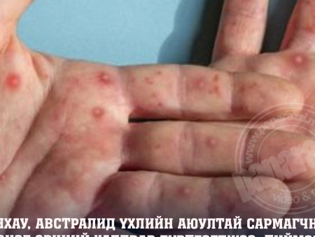 БНХАУ, Австралид үхлийн аюултай сармагчны цэцэг өвчний халдвар бүртгэгджээ. Тиймээс тэдгээр улс руу зорчих иргэд анхаарал болгоомжтой байхыг ХӨСҮТ-өөс анхаарууллаа.
