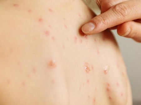 Өмнөговь аймагт улаанбурхан өвчний тохиолдол батлагджээ