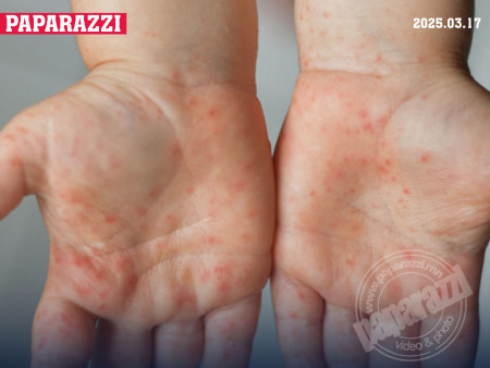 Сүүлийн 24 цагийн дотор Улаанбурхан өвчний 24 тохиолдол батлагдлаа