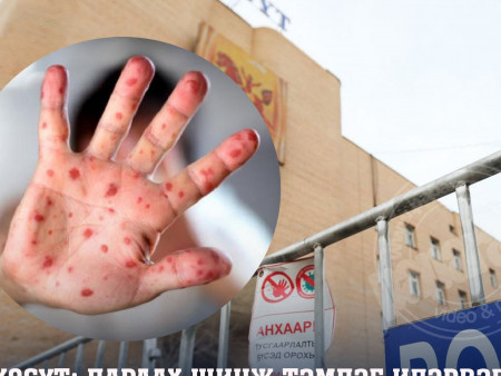 ХӨСҮТ: Дараах шинж тэмдэг илэрвэл эмнэлгийн байгууллагад хандах шаардлагатай