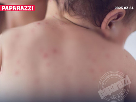 ХӨСҮТ: Улаанбурхан өвчин Улаанбаатар, Өмнөговь, Дундговь аймагт голомтлон бүртгэгдэж байна