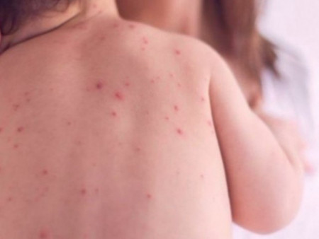 ХӨСҮТ: Улаанбурхан өвчний лабораториор батлагдсан тохиолдол 800 болжээ