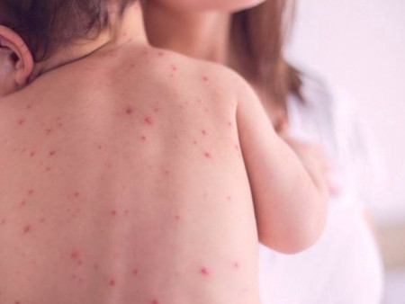 ХӨСҮТ: Улаанбурхан өвчний нийт 428 тохиолдол батлагдаж, хавьтлын тоо 10346-д хүрлээ