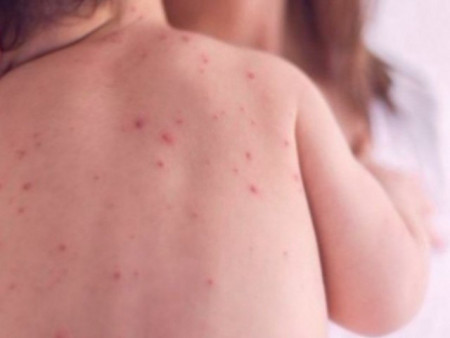 ХӨСҮТ: Улаанбурхан өвчний лабораториор батлагдсан тохиолдол 986 болжээ