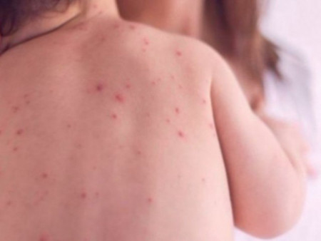 ХӨСҮТ: Улаанбурхан өвчний батлагдсан тохиолдол 955 болж, хавьтлын тоо 11539-д хүрчээ