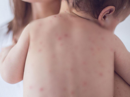 Улаанбурхан өвчний улмаас 111 хүн эмнэлэгт хэвтэн эмчлүүлж байна