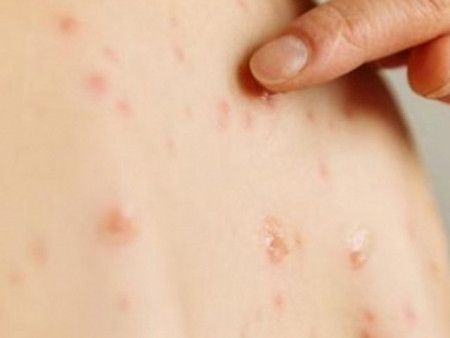 ХӨСҮТ: Улаанбурхан өвчний батлагдсан тохиолдол 1789 болжээ