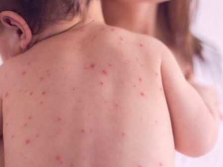 ХӨСҮТ: Улаанбурхан өвчний лабораториор батлагдсан тохиолдол 3547 болжээ