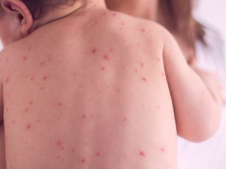 ХӨСҮТ: Улаанбурхан өвчний лабораториор батлагдсан тохиолдол 1964 болжээ