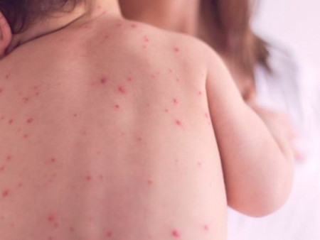 ХӨСҮТ: Улаанбурхан өвчний тохиолдол 8000-ыг давжээ