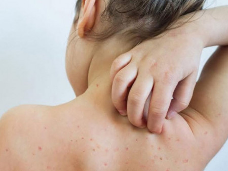 Дархан-Уул аймагт улаанбурхан өвчнөөр 10 хүүхэд, 3 том хүн хэвтэн эмчлүүлж байна