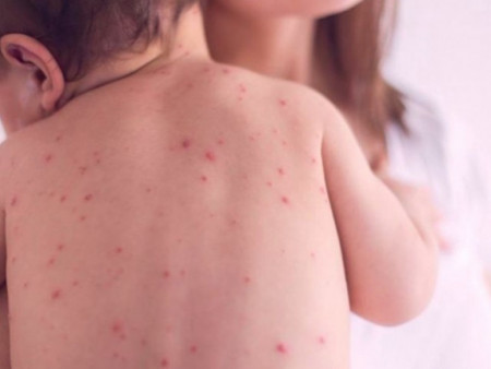 ХӨСҮТ: Улаанбурхан өвчний батлагдсан тохиолдол 10065 болжээ