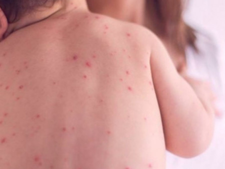 Улаанбурхан өвчнөөр нас барсан тохиолдол зургаа болж нэмэгджээ