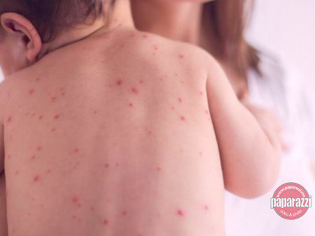 ХӨСҮТ: Улаанбурхан өвчний лабораториор батлагдсан 5075, эмнэлэгт 647 хэвтэн эмчлүүлж байна 2025-06-03 09:09:35