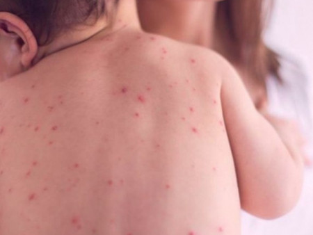 ХӨСҮТ: Улаанбурхан өвчний лабораториор батлагдсан тохиолдол 11338 болжээ