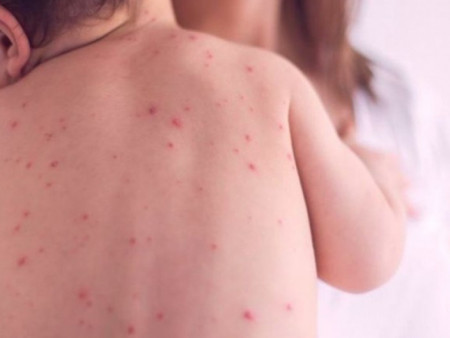 ХӨСҮТ: Улаанбурхан өвчний батлагдсан тохиолдол 11920 болжээ