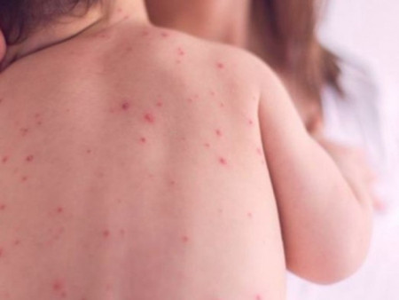 ХӨСҮТ: Улаанбурхан өвчний лабораториор батлагдсан тохиолдол 11179 болжээ