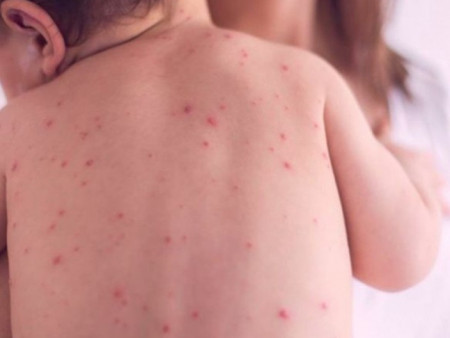 ХӨСҮТ: Улаанбурхан өвчний батлагдсан тохиолдол 12592 болжээ