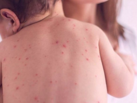 ХӨСҮТ: Улаанбурхан өвчний нийт батлагдсан тохиолдол 13461 болжээ