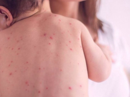 ХӨСҮТ: Улаанбурхан өвчний нийт батлагдсан тохиолдол 13.663 болжээ