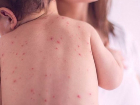 ХӨСҮТ: Улаанбурхан өвчний батлагдсан тохиолдол нэгээр нэмэгдлээ