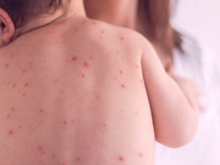 ХӨСҮТ: Улаанбурхан өвчний батлагдсан тохиолдол есөөр нэмэгдлээ