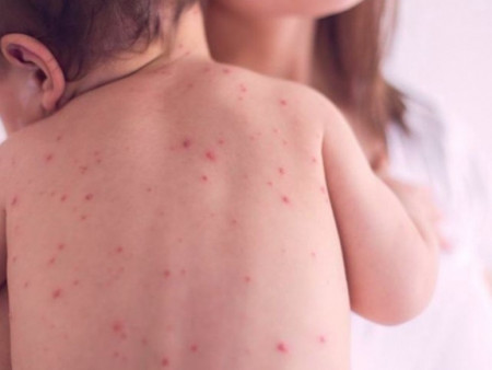 ХӨСҮТ: Улаанбурхан өвчнөөр өвдсөн 5 хүн хэвтэн эмчлүүлж байна