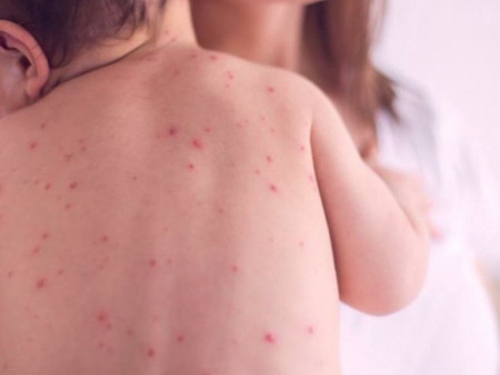 ХӨСҮТ: Улаанбурхан өвчнөөр 6 хүн хэвтэн эмчлүүлж байна