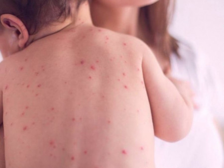 Улаанбурхан өвчний 4 тохиолдол шинээр батлагджээ