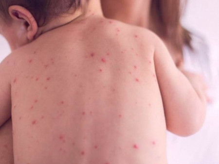 ХӨСҮТ: Улаанбурхан өвчний батлагдсан тохиолдол 15 нэмэгджээ