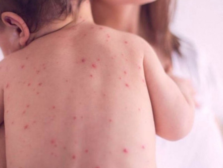 ХӨСҮТ: Улаанбурхан өвчний батлагдсан тохиолдол 9 нэмэгджээ