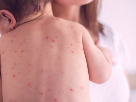 Нэг өдөрт буюу өчигдөр Улаанбурхан өвчний 25 тохиолдол бүртгэгджээ