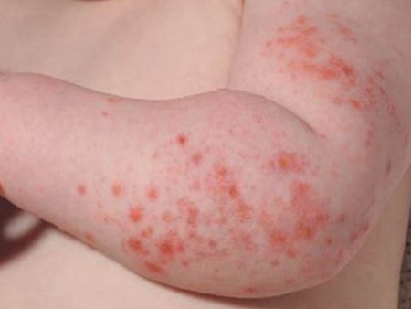 ХӨСҮТ: Монгол Улсын хэмжээнд менингококкт халдварын батлагдсан 5 тохиолдол бүртгэгджээ